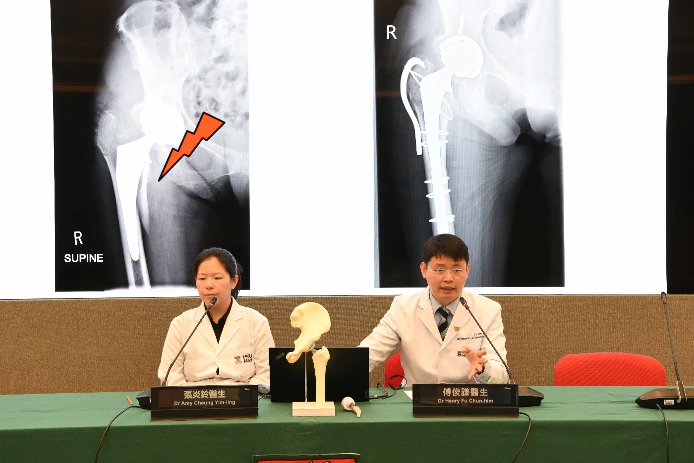 HKUMed study demonstrates that robotic total hip replacement has a lower reoperation rate than the conventional technique. The research team members include Dr Henry Fu Chun-him (right) and Dr Amy Cheung Yim-ling.