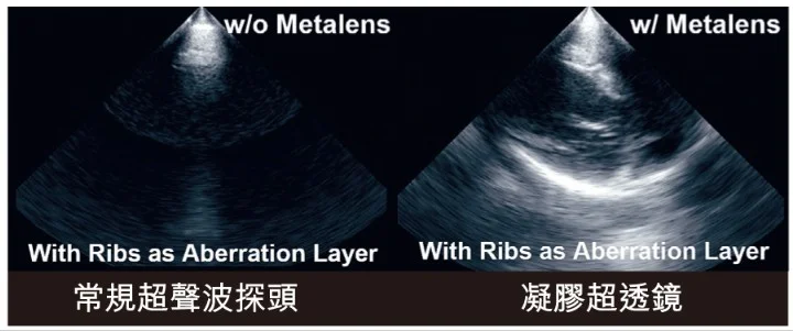 HKU Develops “AI-powered Metalens” to Break Ultrasound Barriers and Enhance Diagnosis Precision
