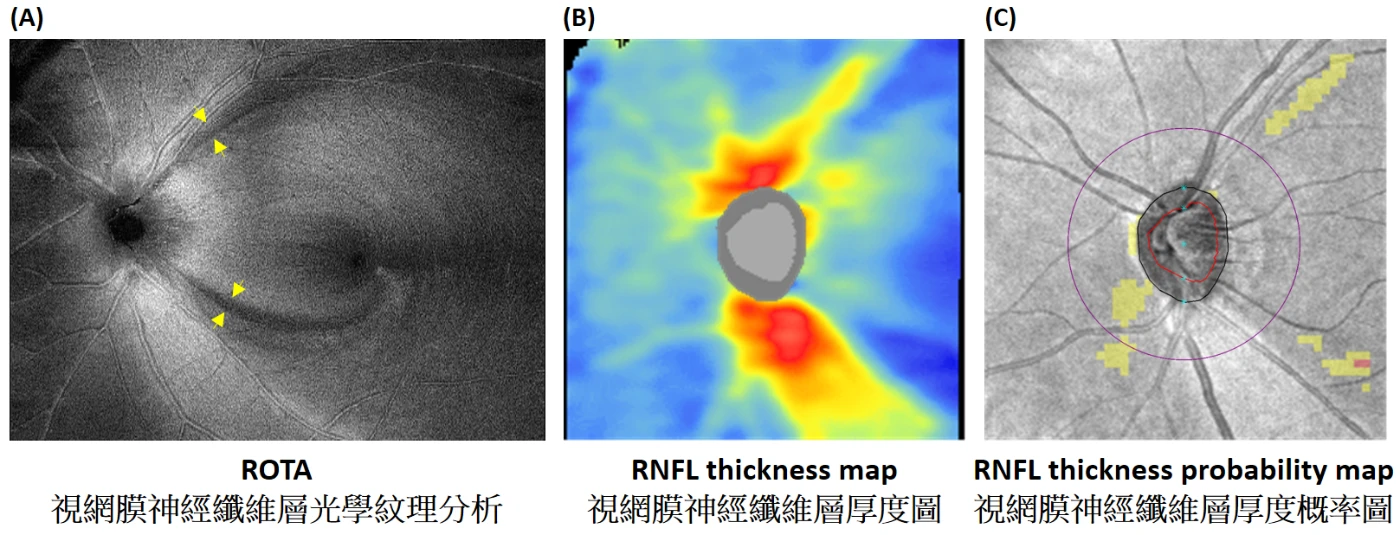 港大醫學院與中大醫學院聯合研發嶄新ROTA技術<br>
可診斷出早期青光眼和視神經病變