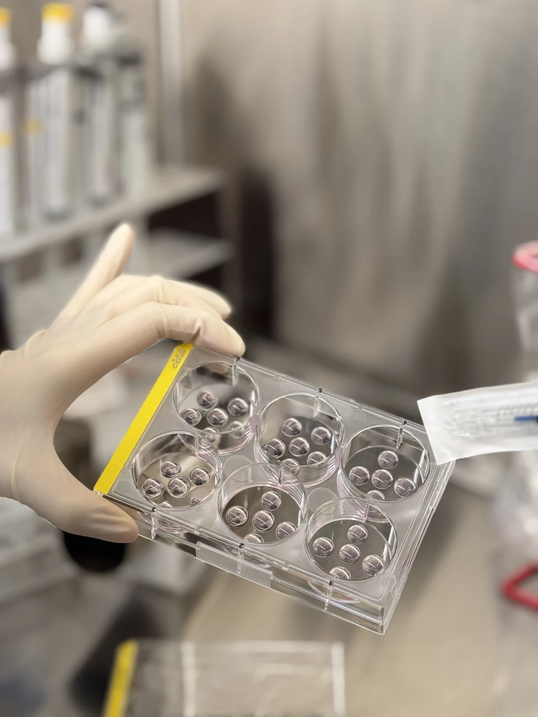 The HKUMed research team grew a collection of 70 organoids from tissue samples of cancer patients at Queen Mary Hospital, providing a realistic model for studying the progression of intestinal metaplasia to cancer.