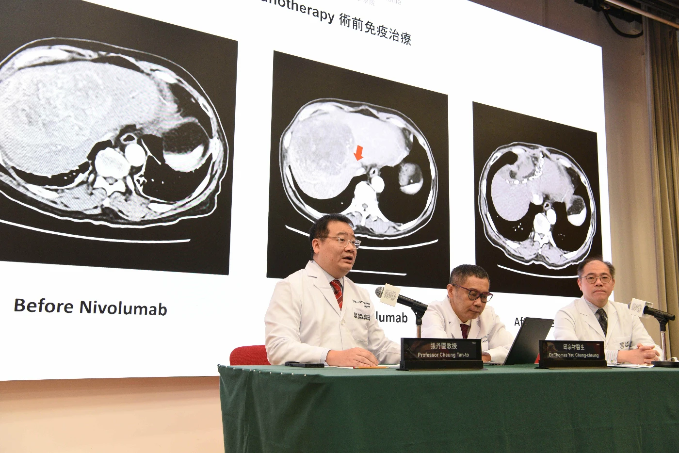 Following the significant effects of the ‘dual immunotherapy’, the new combination treatment has been approved from the FDA, EMA and NMPA for previously untreated advanced HCC patients. The research team includes (from left) Professor Cheung Tan-to, Dr Thomas Yau Chung-cheung and Dr Ronald Leung Ching-yu.
