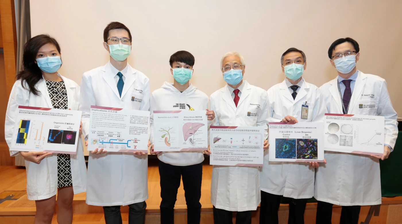 港大醫學院發現β-澱粉樣蛋白異常沉積是膽道閉塞的新發病機制