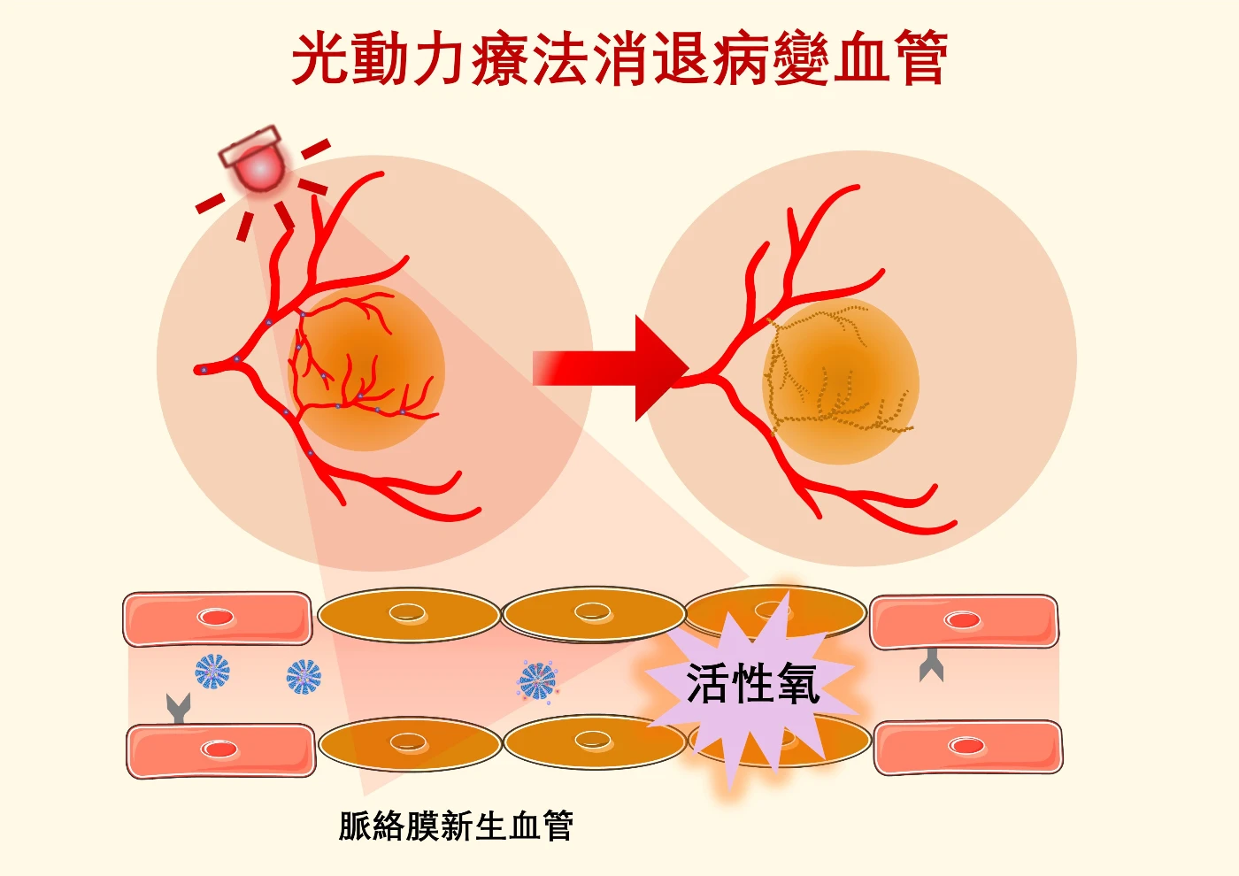 光動力療法提供一種臨床解決方案，利用特定波長的光照激活無毒光敏藥物，產生活性氧，從而破壞和清除病變血管。